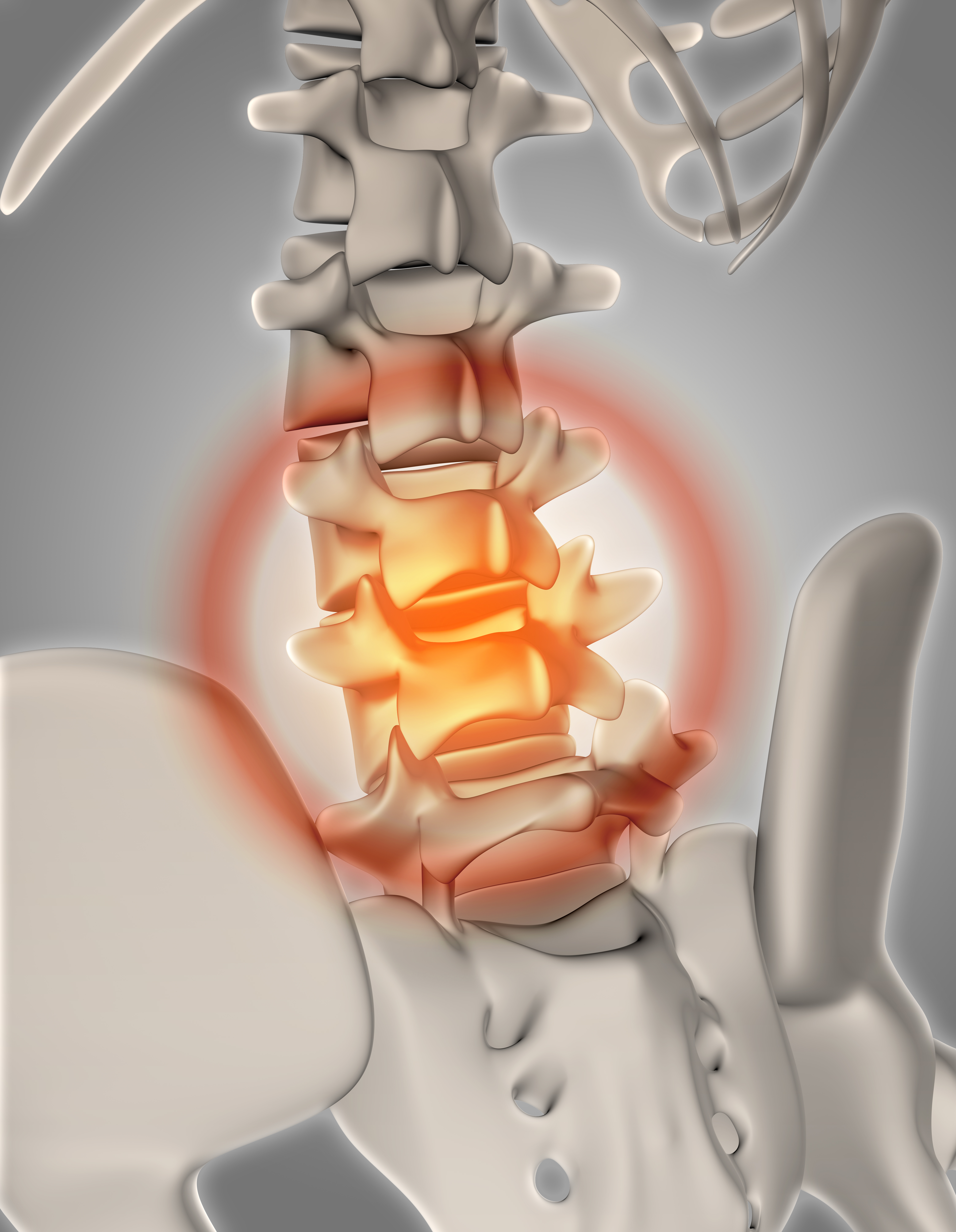 Slip Disc Prolapse